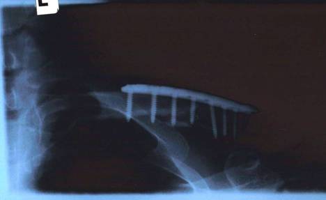 collarbone_plate_2008.jpg